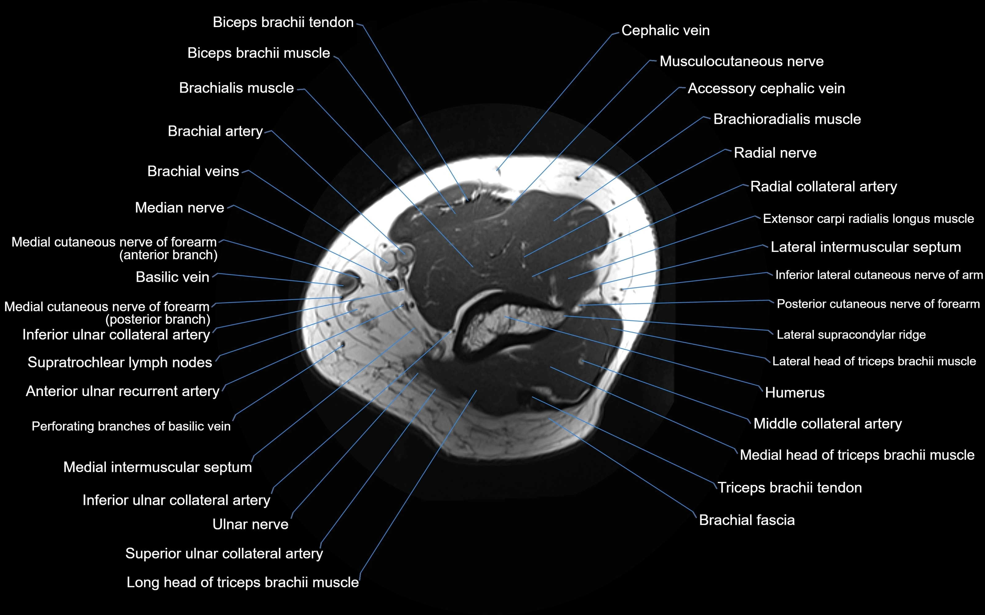 MRI elbow axial cross sectional anatomy 3T  radiology  image-img-00001-00005.webp